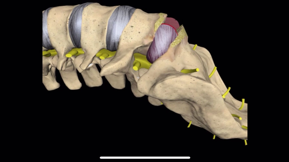 Anterior Lumbar Interbody Fusion with cage - (ALIF) Technique